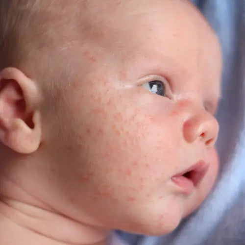 baby acne