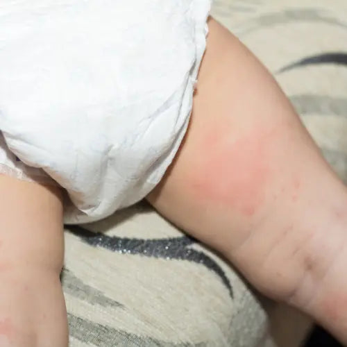 How to Deal with Diaper Rashes in the Rainy Season