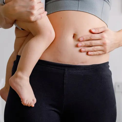 C-section Recovery