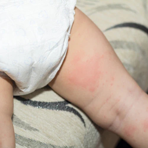 Baby Diaper Rash