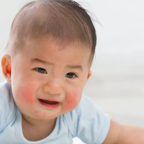 Food Allergies in Babies