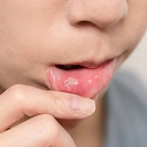 Home Remedies for Mouth Ulcers in Kids