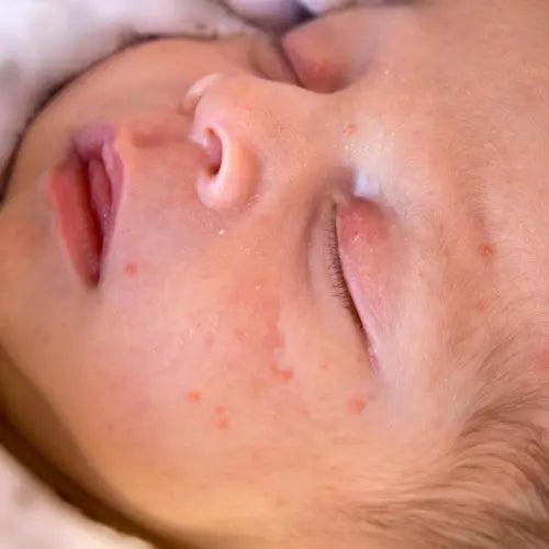 baby acne