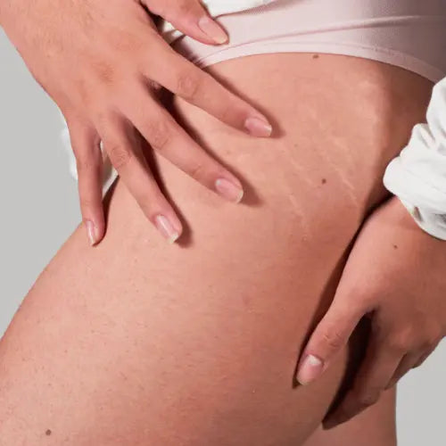 Period Rash