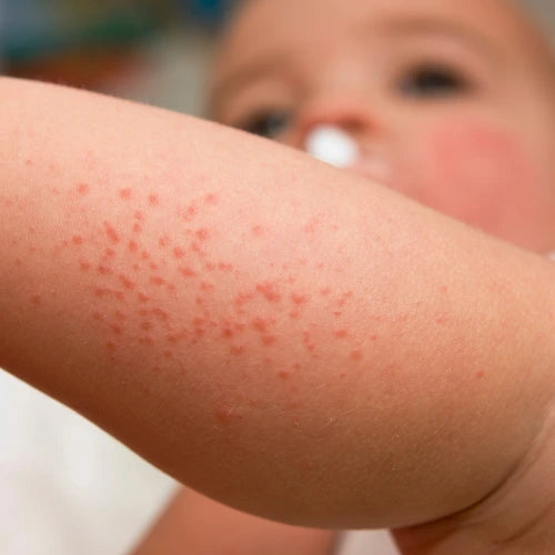 Rashes in babies 